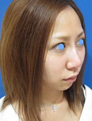 目の下のたるみ、目のくまでお悩みの方、切らずに完璧に解決します。TCB-R法　手術直後　症例写真